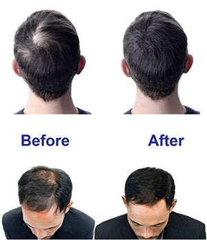 The ONLY 88 Diodes Cap WITH Smart App (iPhone) Laser Hair Growth Cap